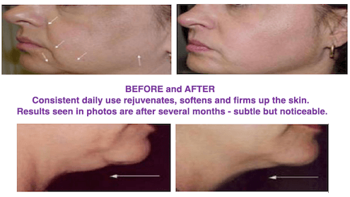 Before
and After