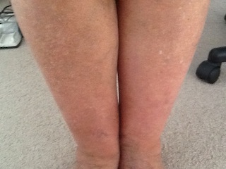 Cellulitis
2